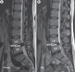 Spine Treatment